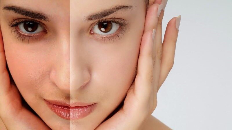 کمک به درمان مشکلات پوستی با زینک و زینک-PCA | بهترین کلینیک زیبایی اصفهان